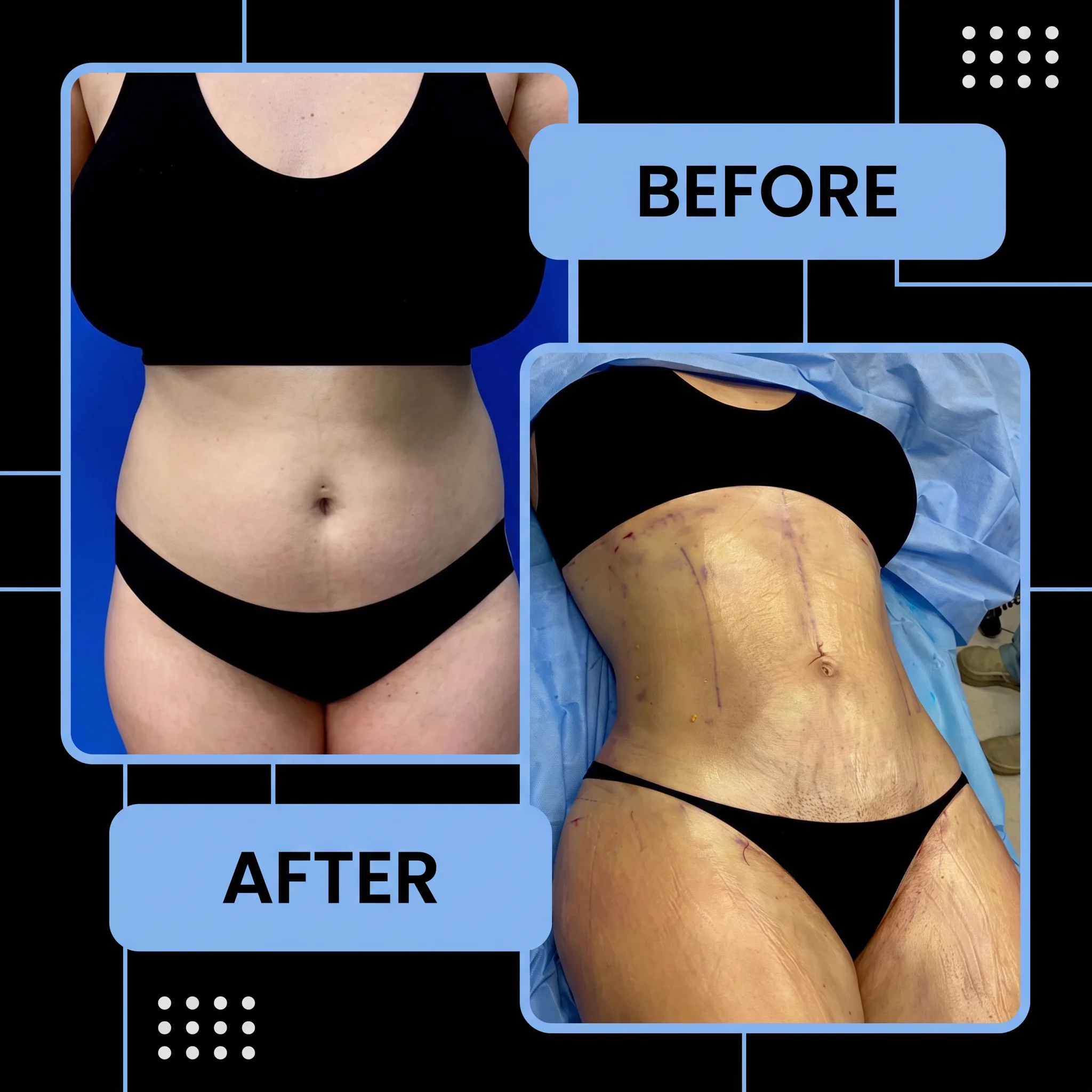 360 Liposuction