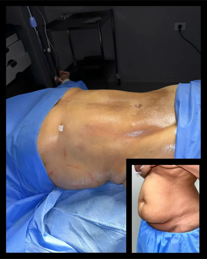 liposuction